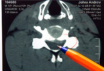 The light grey area highlighted by the arrow shows the calcified disc bulging into Johns' spinal column, which is indicated by the pen. The disc is one centimetre from severing his spinal cord.